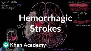 Hemorrhagic strokes  Circulatory System and Disease  NCLEXRN  Khan Academy [upl. by Yssirc]