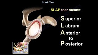 SLAP Tear  Everything You Need To Know  Dr Nabil Ebraheim [upl. by Eserahs]