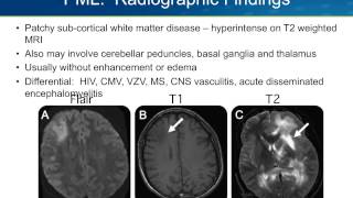 Progressive Multifocal Leukoencephalopathy PML [upl. by Elinet267]