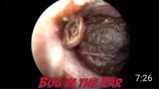 How to Drain Inner Ear Infection [upl. by Froemming]