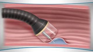 Cardiopulmonary bypass CPB circuit [upl. by Akem]