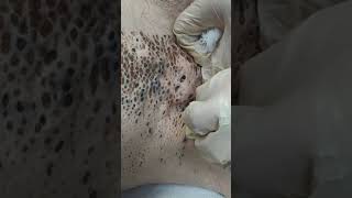 Nevus Comedonicus removal [upl. by Annairba]