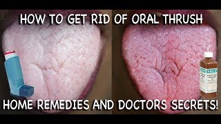 How to Treat Candida at Home Doctors Advice [upl. by Eckmann183]