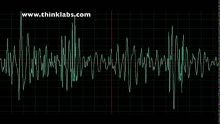 Atrial Septal Defect [upl. by Eclud]