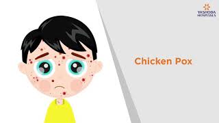 Chicken Pox Symptoms Causes Prevention and Treatment  Yashoda Hospitals [upl. by Ahsyla]