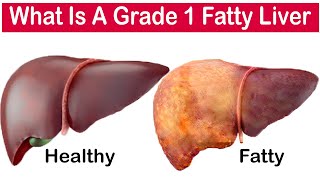 What is a grade 1 fatty liver [upl. by Nylekcaj]