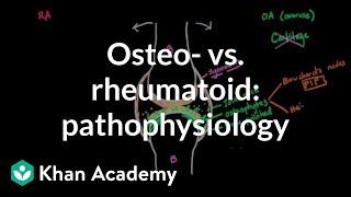 Osteoarthritis vs rheumatoid arthritis pathophysiology  NCLEXRN  Khan Academy [upl. by Atirahs]