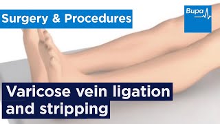 How varicose vein ligation and stripping is carried out  Bupa Health [upl. by Nwahsaj328]