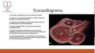 Estenosis mitral [upl. by Thayne]