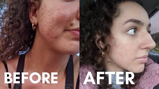 DID DOXYCYCLINE WORK  My Doxycycline Experience Doxycycline for Acne Before and After Pictures [upl. by Enriqueta]