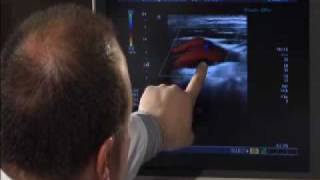 CAROTID ULTRASOUND THE CAROTID BIFURCATION [upl. by Collayer165]