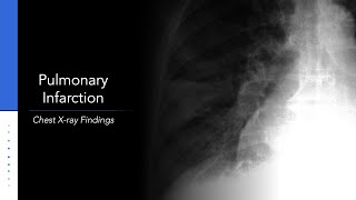 CTguided Lung Biopsy procedure and technique [upl. by Airrehs]