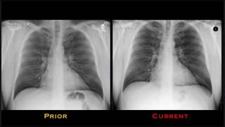 Port placement for interventional radiology  Ohio State Medical Center [upl. by Fassold]