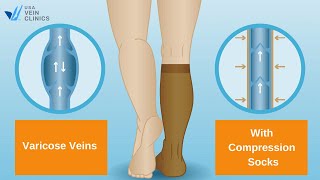 Treatment for varicose veins  VenaSeal Closure System  Medtronic India [upl. by Anizor]