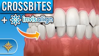 Can Invisalign Fix Crossbites [upl. by Ennairrek628]