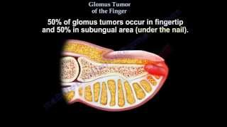 NEOPLASIA1 BASICS Nomenclature Benign Malignant Mixed tumors teratomaHamartoma choristoma [upl. by Lassiter]