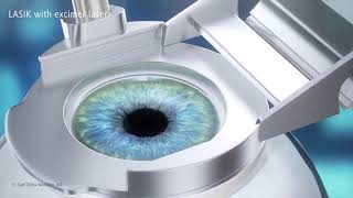 How Does LASIK Work [upl. by Tenej]