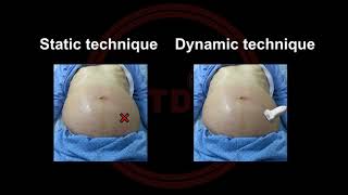 Ultrasonography Guided Paracentesis [upl. by Edrahs]