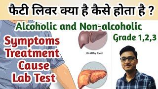 fatty liver in hindi  Fatty Liver diseases symptoms  Alcoholic vs Nonalcoholic fatty liver [upl. by Lednyk]