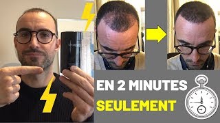 Greffe de cheveux  Le REMÈDE ANTICHUTE de Cheveux PostIntervention 😱 [upl. by Ellenyl]