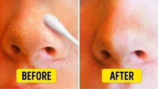 9 Natural Ways to Get Rid of Blackheads on Nose [upl. by Cathrine]