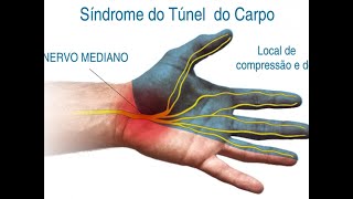 SÍNDROME DO TÚNEL DO CARPO DESSE JEITO VOCÊ VAI ENTENDER [upl. by Kimbell716]