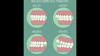 Different Types of Malocclusions [upl. by Notlaw]