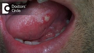 blisters from mosquito bites  before and after treatment [upl. by Emili436]