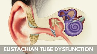 What is Eustachian Tube Dysfunction [upl. by Gaven]