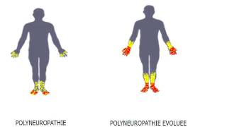 Autonomic Neuropathy Life Expectancy Prognosis [upl. by Tamar248]