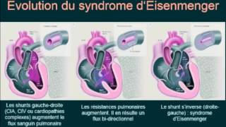 vivreaveclhtpca  scintigraphie de perfusionventilation VQ [upl. by Ayekam]