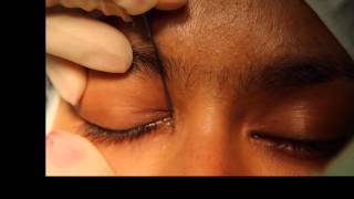 Lacrimal probing and syringing [upl. by Alomeda]