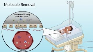 Peritoneal Dialysis by S Su A Olszewski  OPENPediatrics [upl. by Elak]