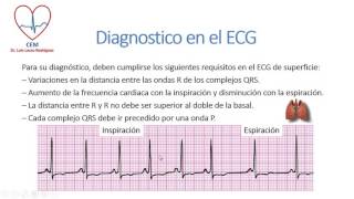 Arritmia sinusal respiratoria [upl. by Trainer]