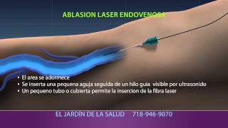 Animation of Ablación Laser Endovenosa [upl. by Cooke]