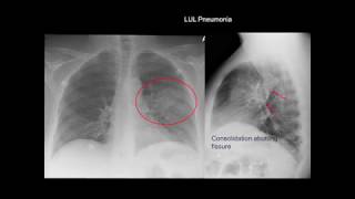 Chest Xray Cases 1 [upl. by Asssilem]