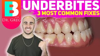 BRACES EXPLAINED Underbite  Crossbite Correction [upl. by Fitzger]