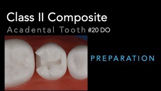 Class II Composite Preparation  Acadental Tooth 20 DO [upl. by Suki970]