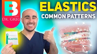 BRACES ELASTICS Most Common Patterns for Braces [upl. by Llerraf]