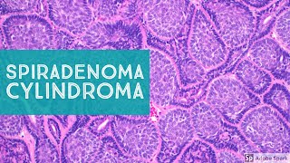 Spiradenoma amp CylindromaSweat Gland Tumor Pathology [upl. by Herculie]