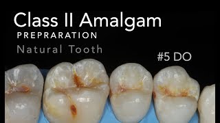 Class II Amalgam Preparation  5 DO Natural Tooth [upl. by Paley69]