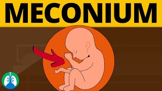 Meconium Aspiration Syndrome Medical Definition  Quick Explainer Video [upl. by Dugaid]