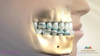 Orthodontic Treatment for Underbite or Crossbite  Carriere Appliance [upl. by Adnawuj]