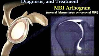 SLAP Tear Symptoms Diagnosis And Treatment  Everything You Need To Know  Dr Nabil Ebraheim [upl. by Paugh988]