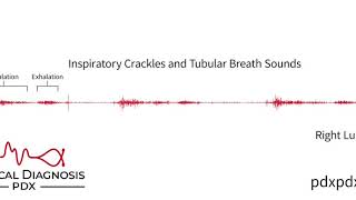 The Lung Sounds of Pneumonia [upl. by Atsedom]