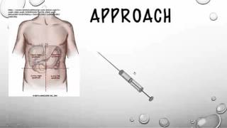 The Therapeutic Paracentesis tricks of the trade [upl. by Zelle]