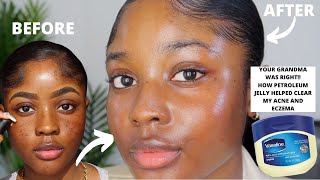 HOW VASELINE HELPED CLEAR MY ACNE AND EZCEMA FASTER  KAISERCOBY [upl. by Ynittirb510]