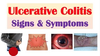 Ulcerative Colitis Pathophysiology Symptoms Risk factors Diagnosis and Treatments Animation [upl. by Christye495]