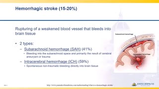 Hemorrhagic Stroke Recovery  Week 3 [upl. by Ivo]