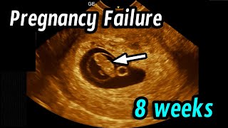 Early pregnancy failure 8 weeks 2 days [upl. by Hanselka]